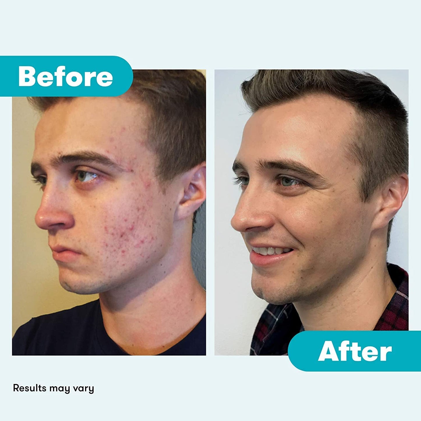 Proactiv Acne Cleanser - Benzoyl Peroxide Face Wash and Acne Treatment - Daily Facial Cleanser and Hyularonic Acid Moisturizer with Exfoliating Beads - 90 Day Supply, 6 Oz